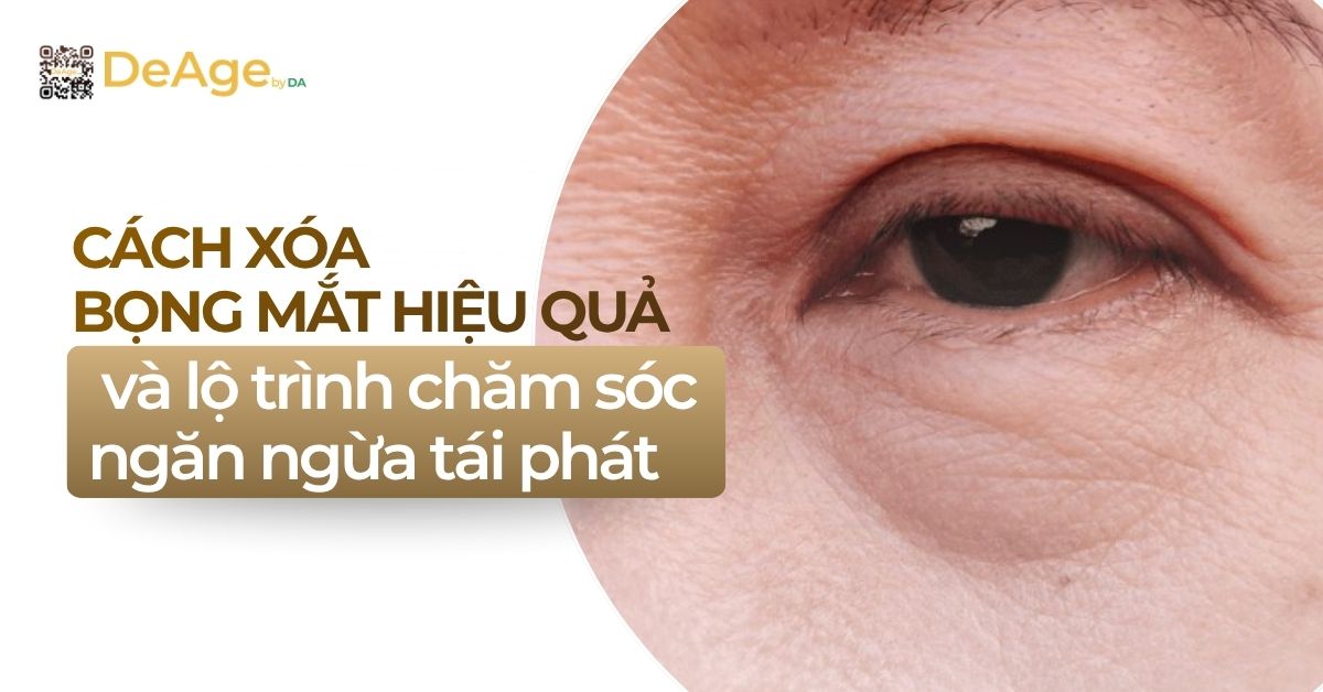 thumb cách xóa bọng mắt hiệu quả và lộ trình chăm sóc ngăn ngừa tái phát
