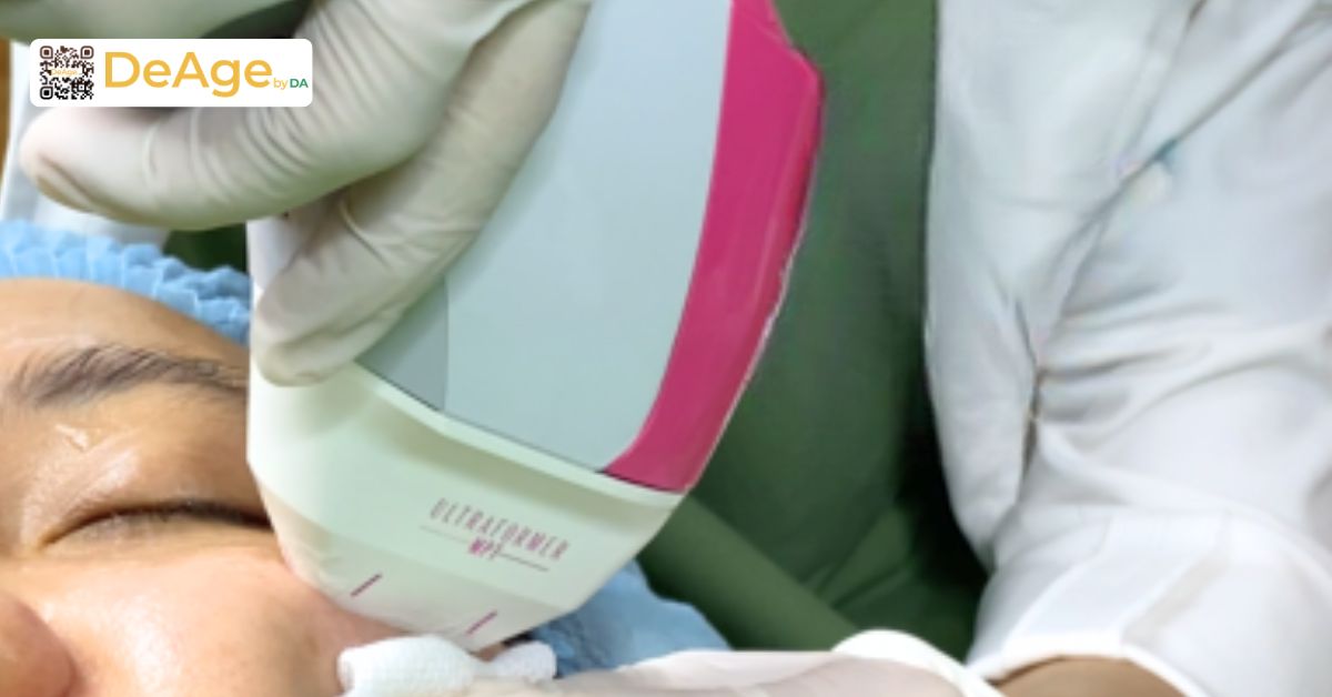 Căng chỉ collagen: cơ chế hoạt động và hiệu quả nâng cơ trẻ hóa da 10 ultraformer MPT vùng mắt tại Deage by DA hỗ trợ làm săn chắc da quanh mắt