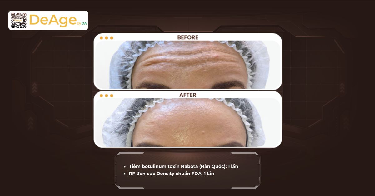 Tiêm xóa nhăn trán có hiệu quả không và nên chọn phương pháp nào? 9 cls tiêm botox