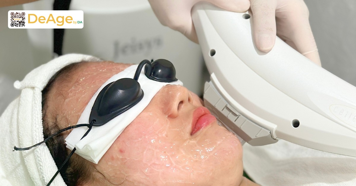 Các phương pháp làm sáng da phổ biến giúp cải thiện làn da sạm màu 11 Ánh sáng xung mạnh IPL