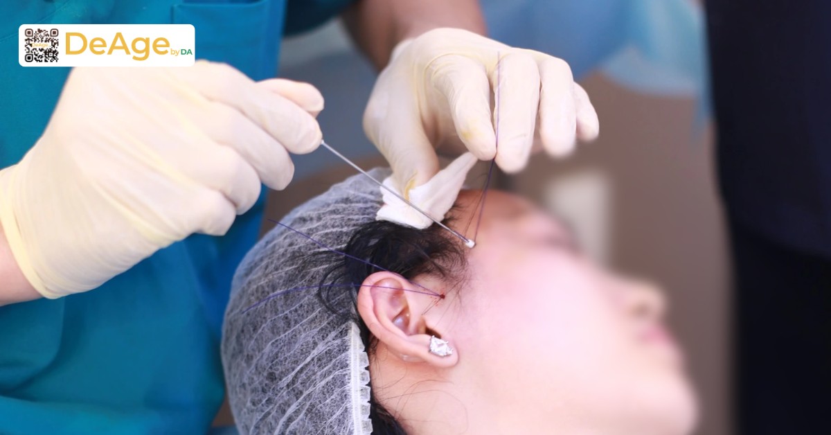 Căng chỉ collagen: cơ chế hoạt động và hiệu quả nâng cơ trẻ hóa da 1 Bác sĩ thực hiện căng chỉ