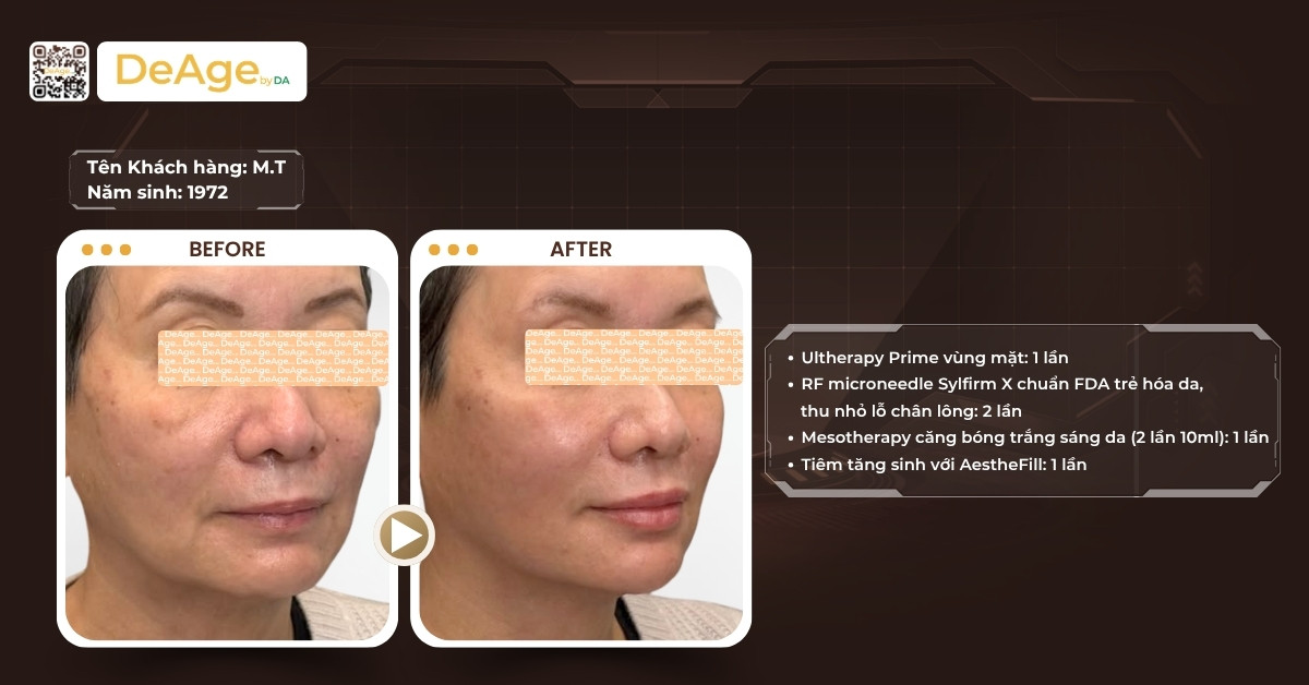 Công nghệ nâng cơ Ultherapy giá bao nhiêu? Chi phí có xứng đáng với hiệu quả? 7 CLS LDP Ultherapy Prime
