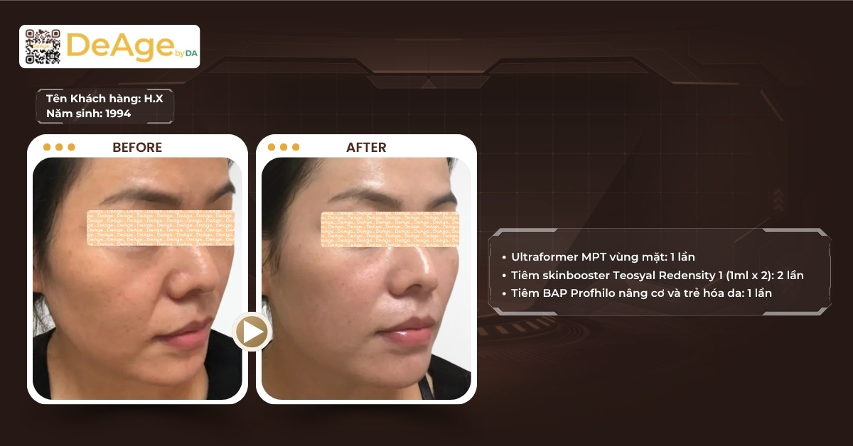 So sánh HIFU và Thermage trong nâng cơ trẻ hóa da 8 CLS nâng cơ bằng HIFU