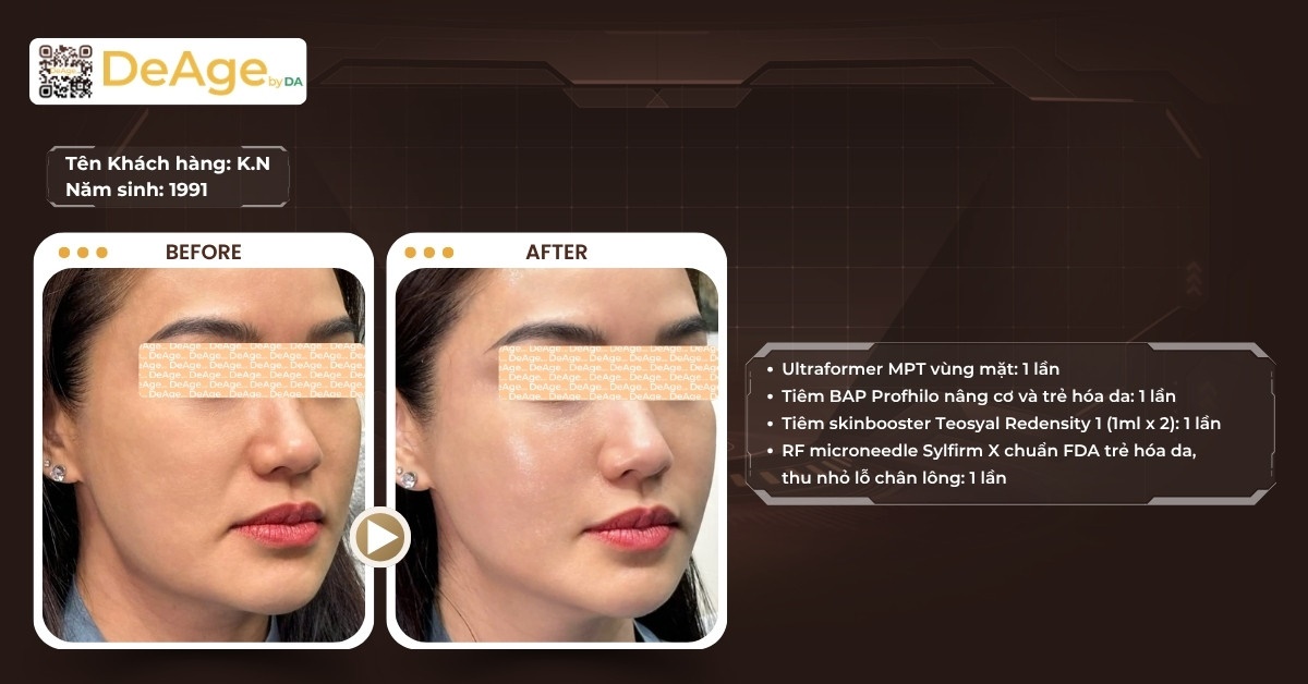 Căng chỉ collagen: cơ chế hoạt động và hiệu quả nâng cơ trẻ hóa da 15 CLS nâng cơ trẻ hóa