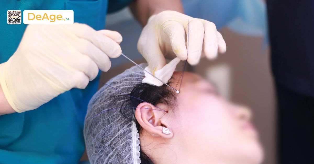 Căng da mặt không phẫu thuật: giải pháp trẻ hóa da an toàn, không cần nghỉ dưỡng 7 Căng chỉ