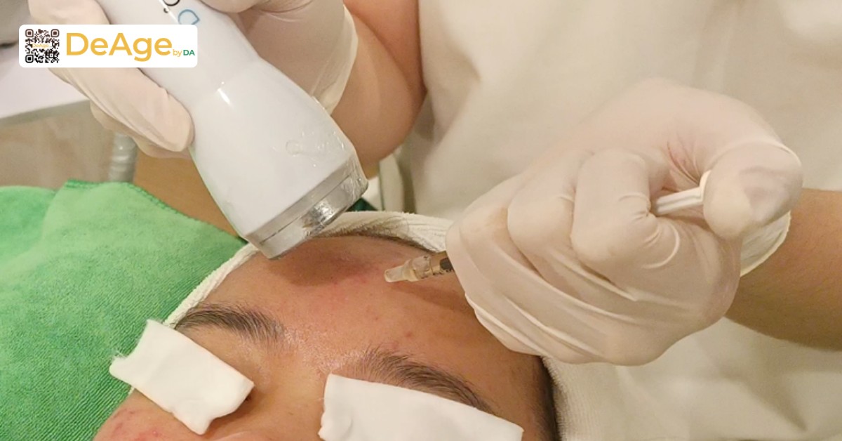 Các phương pháp làm sáng da phổ biến giúp cải thiện làn da sạm màu 15 Điện di vitamin C
