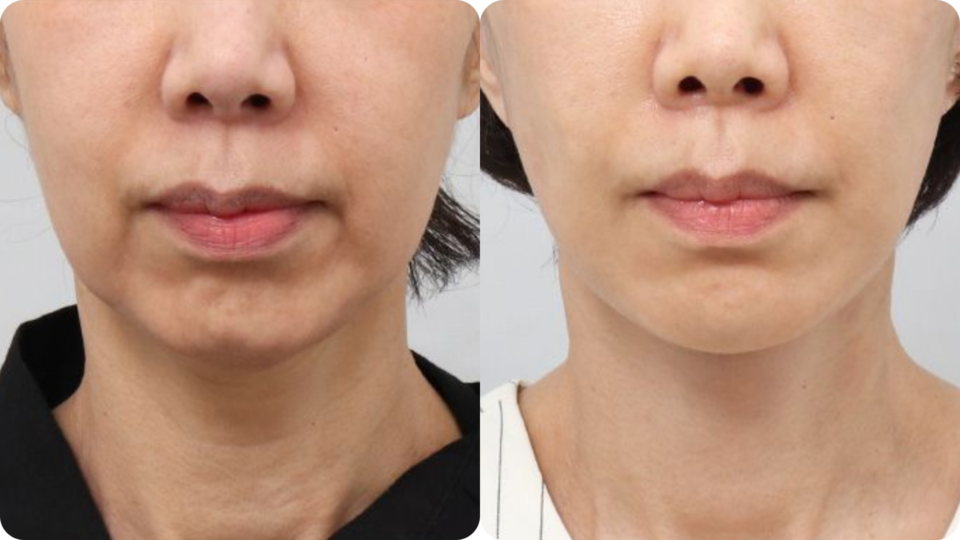 Ultherapy Prime 8