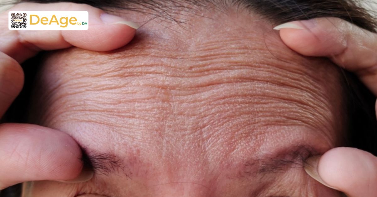 Tiêm botox xóa nhăn: giải pháp cải thiện nếp nhăn và trẻ hóa gương mặt 5 Đối tượng nên và không nên tiêm botox xóa nhăn