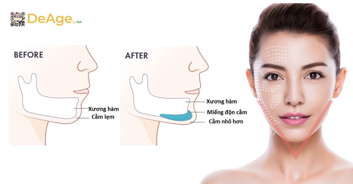 Mặt V-line là gì? Cách tạo gương mặt V-line thon gọn an toàn và hiệu quả 4 Độn cằm