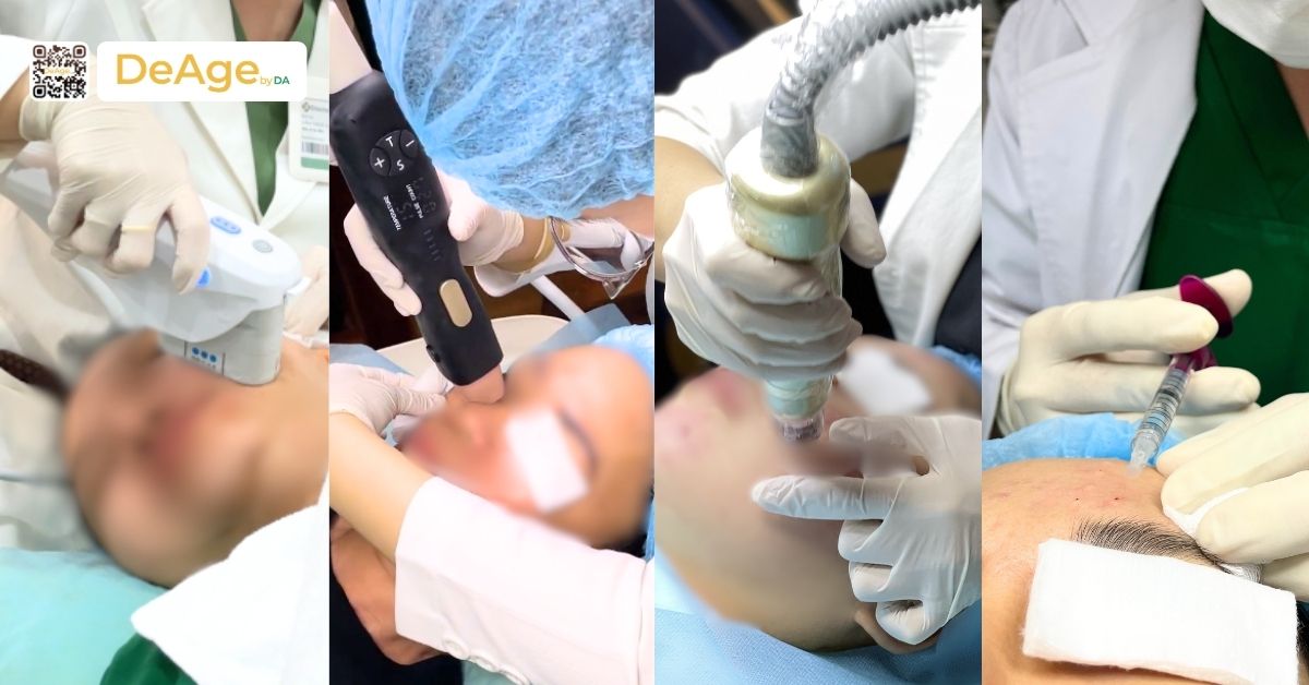 Căng da mặt không phẫu thuật: giải pháp trẻ hóa da an toàn, không cần nghỉ dưỡng 1 Hifu + density + sylfirm + tiêm