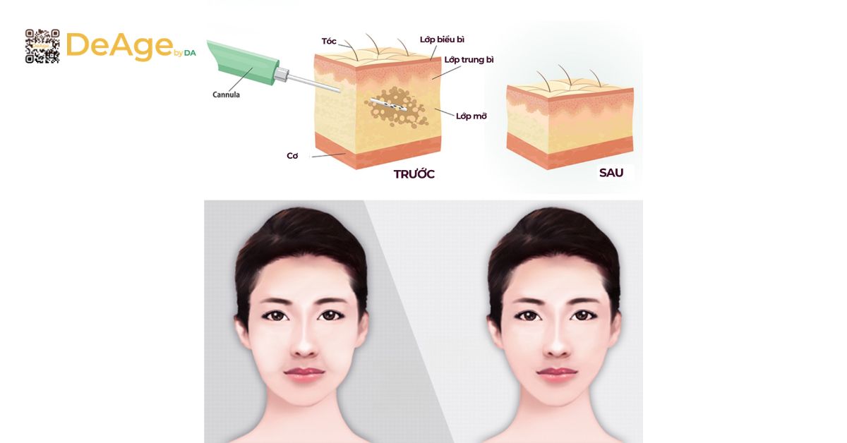 Mặt V-line là gì? Cách tạo gương mặt V-line thon gọn an toàn và hiệu quả 6 Hút mỡ mặt