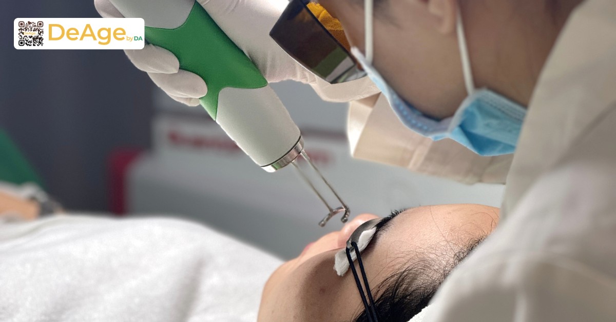Các phương pháp làm sáng da phổ biến giúp cải thiện làn da sạm màu 10 Laser Pico