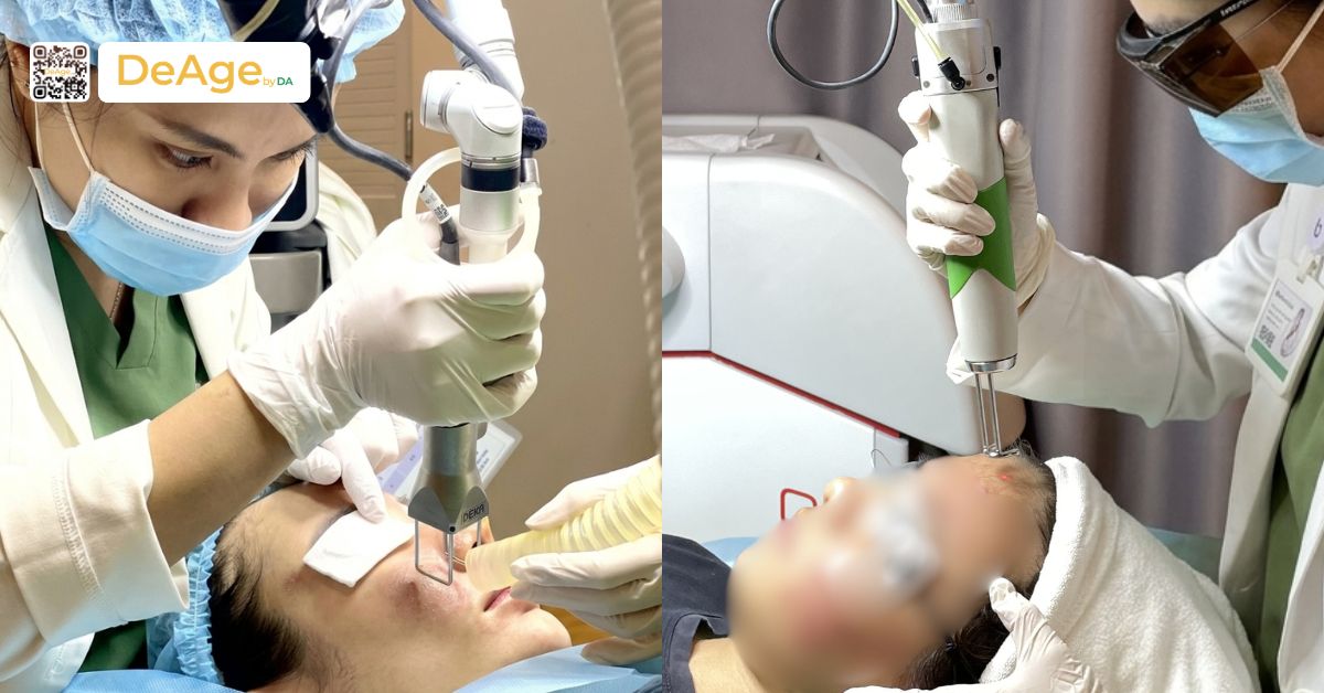 Nguyên nhân da sần sùi và cách cải thiện để làn da mịn màng hơn 9 Laser trẻ hóa da DEKA PICO