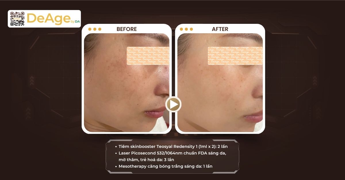 Cách chăm sóc da sau khi bắn laser trị nám giúp phục hồi nhanh và hạn chế tăng sắc tố 7 cls trị nám