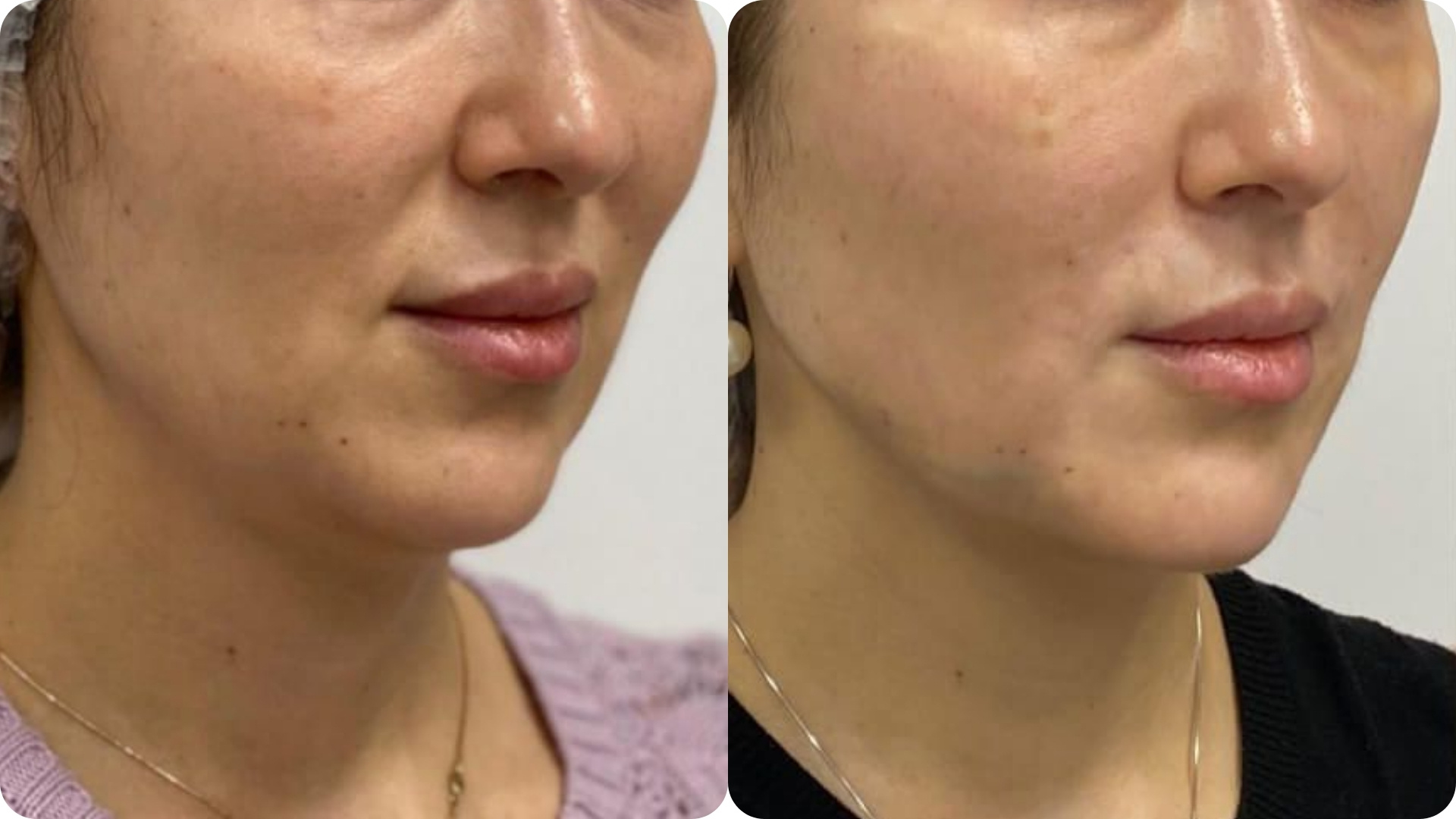 Ultherapy Prime 2