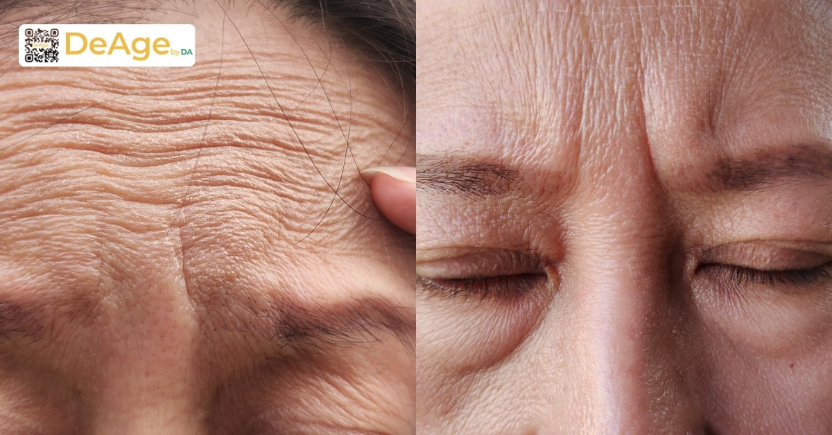 Botox có tác dụng gì và hiệu quả duy trì trong bao lâu? 3 Nếp nhăn trán và nhăn cau mày
