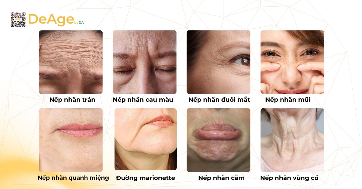 Tiêm botox xóa nhăn: giải pháp cải thiện nếp nhăn và trẻ hóa gương mặt 3 Những nếp nhăn có thể cải thiện bằng botox