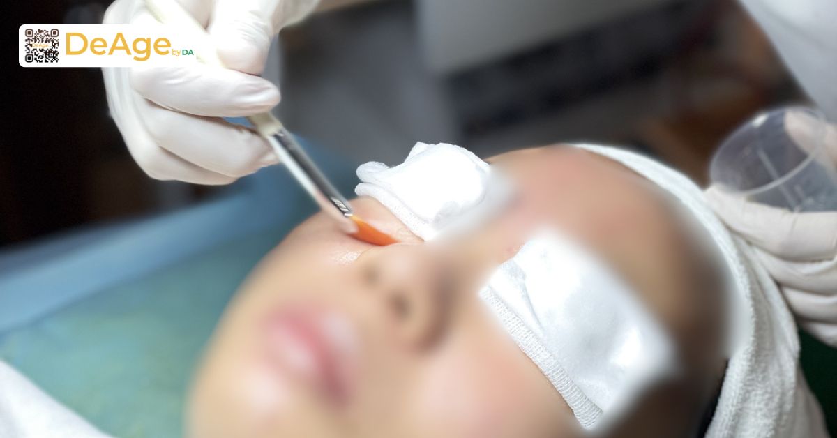 Các phương pháp xóa nhăn đuôi mắt từ chăm sóc da đến can thiệp chuyên sâu 12 Peel da hóa học