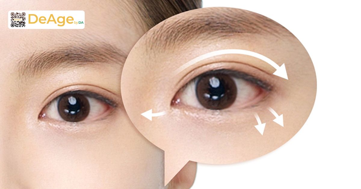 Nâng cơ mí mắt: bí quyết giúp vùng mắt trẻ trung và tươi tắn hơn 9 Phẫu thuật mí mắt (blepharoplasty)
