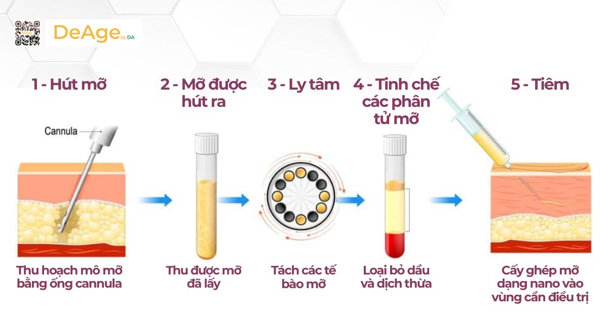 Cấy mỡ tự thân lên mặt: ưu điểm, hiệu quả và đối tượng phù hợp 2 Quy trình cấy mỡ mặt tự thân (hình minh họa)