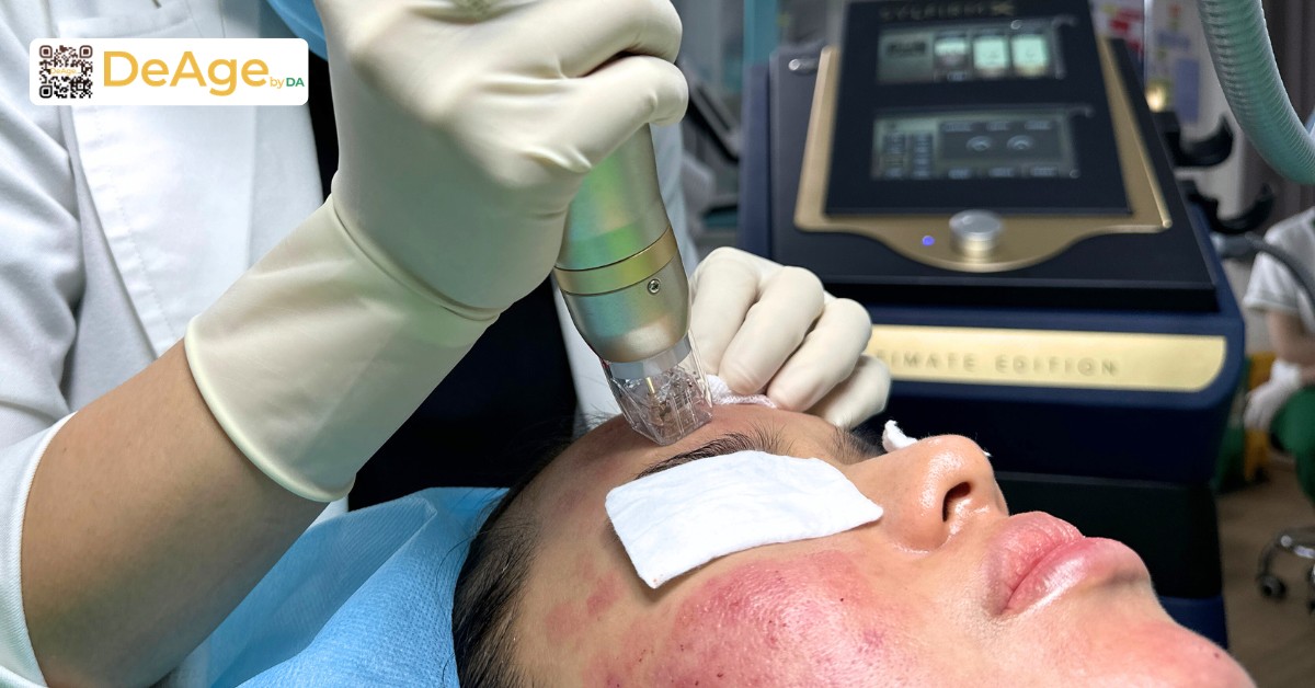 Các phương pháp làm sáng da phổ biến giúp cải thiện làn da sạm màu 12 RF Sylfirm X