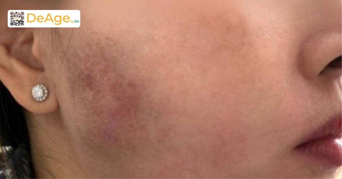Căng chỉ collagen: cơ chế hoạt động và hiệu quả nâng cơ trẻ hóa da 9 Sưng bầm sau căng chỉ