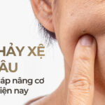 Da chảy xệ do đâu và giải pháp nâng cơ an toàn hiện nay