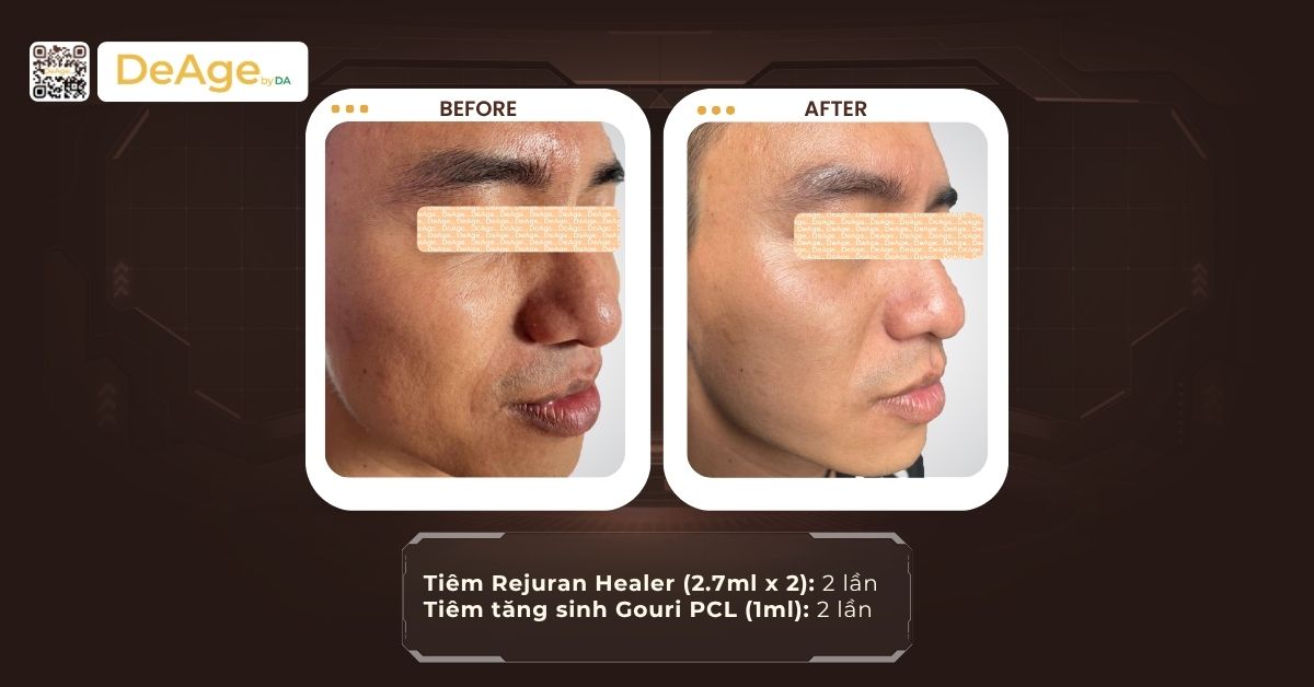 Căng da mặt không phẫu thuật: giải pháp trẻ hóa da an toàn, không cần nghỉ dưỡng 12 Tiêm Rejuran Healer (2.7ml x 2) 2 lần