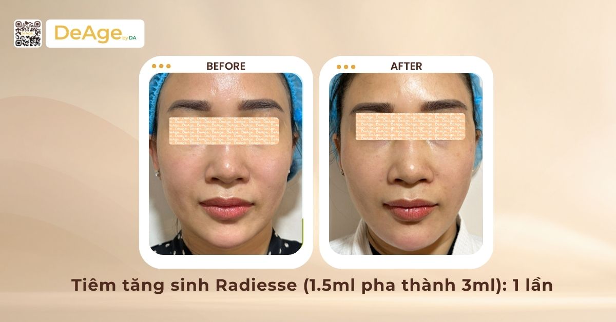 Cấy mỡ tự thân lên mặt: ưu điểm, hiệu quả và đối tượng phù hợp 8 Ca lâm sàng trẻ hóa da tại DeAge by DA