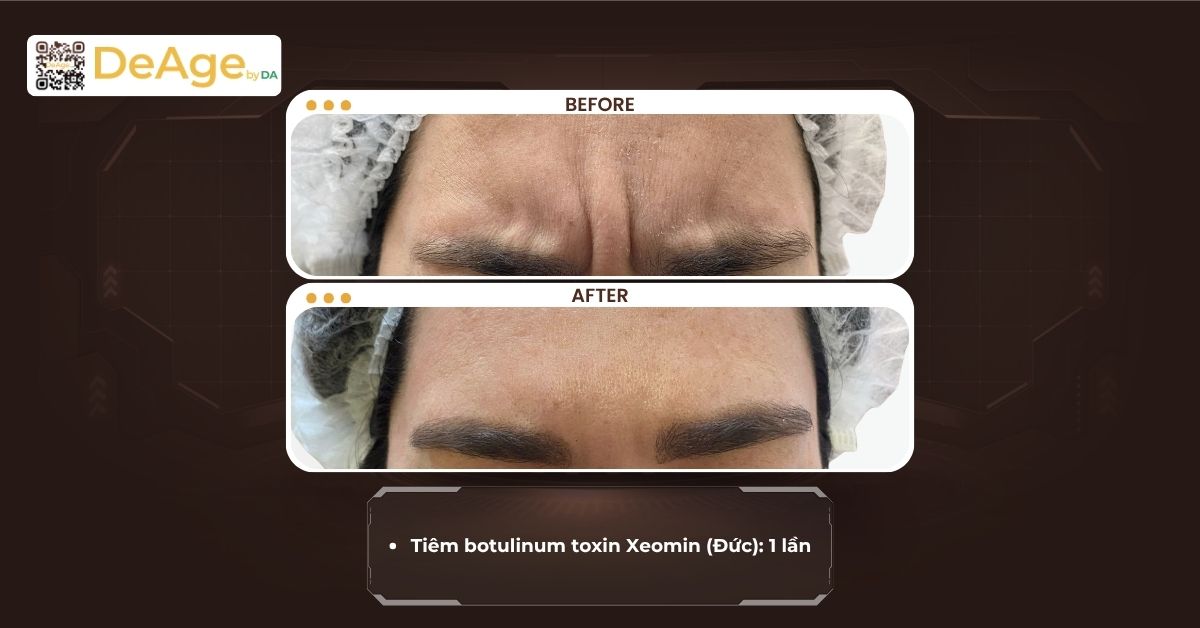 Tiêm botox kiêng gì để đạt hiệu quả tốt và hạn chế tác dụng phụ 6 cls tiêm botox