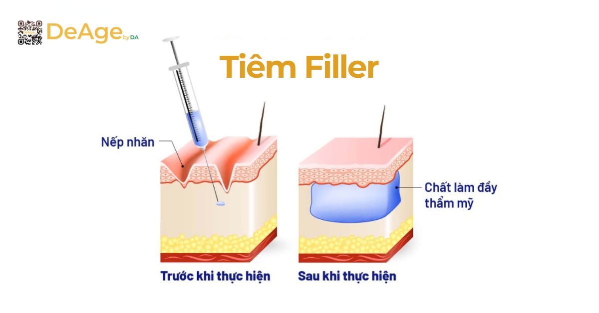 Tiêm filler má hóp: khôi phục nét đầy đặn tự nhiên và cân đối gương mặt 1 Tiêm filler má hóp là gì