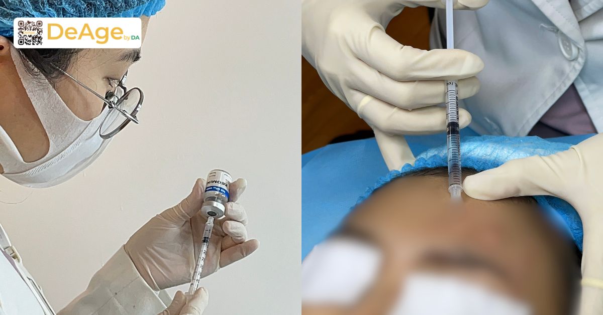 Tiêm botox bị sưng: nguyên nhân và cách giảm sưng nhanh, an toàn 7 Trước khi thực hiện