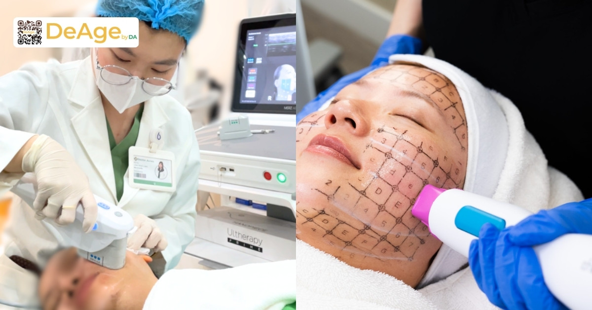 Ultherapy và Thermage: đâu là giải pháp phù hợp trong nâng cơ, trẻ hóa da? 5 Ultherapy và Thermage