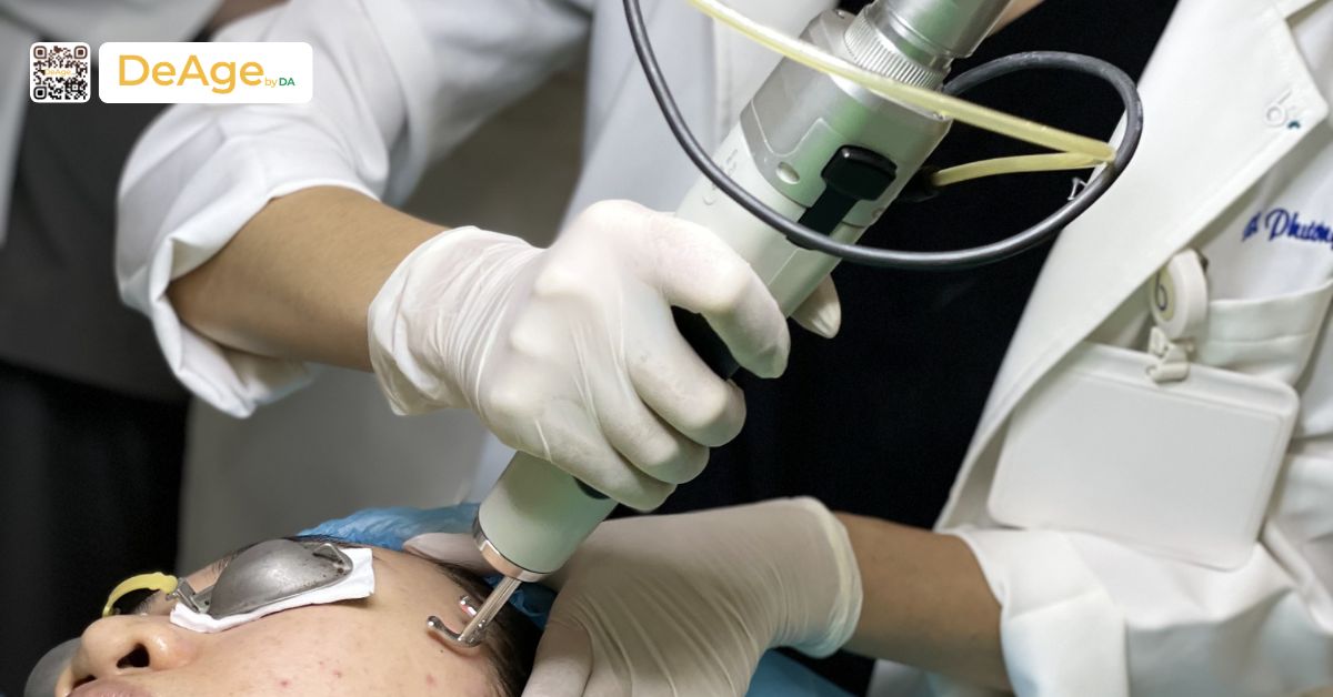 Top 11 cách xóa nếp nhăn vùng mắt an toàn và hiệu quả hiện nay 10 bsi thực hiện laser fractional co2