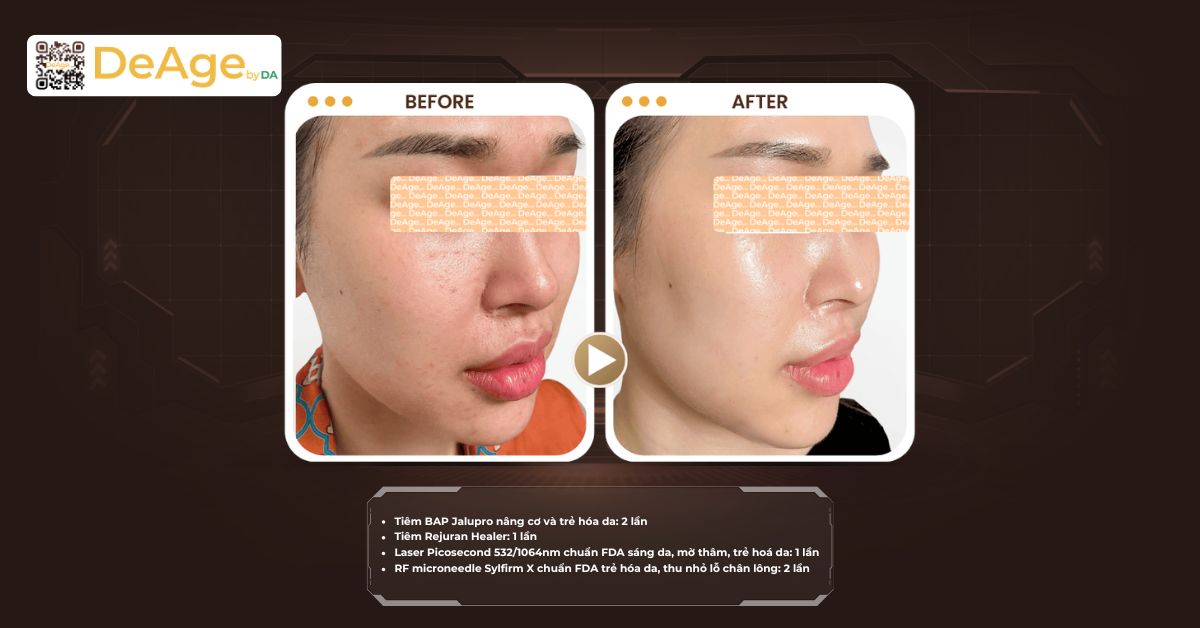 Mặt V-line là gì? Cách tạo gương mặt V-line thon gọn an toàn và hiệu quả 12 cls ldp