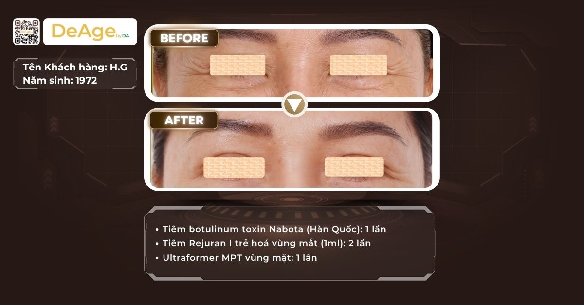 Top 11 cách xóa nếp nhăn vùng mắt an toàn và hiệu quả hiện nay 17 cls mắt (top 11) (1)