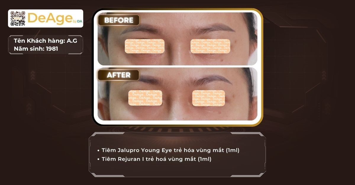 Rãnh lệ là gì? Nguyên nhân và cách cải thiện an toàn 11 Ca lâm sàng trẻ hóa vùng mắt tại DeAge by DA