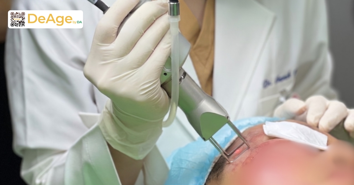 Cách chăm sóc da sau khi bắn laser trị nám giúp phục hồi nhanh và hạn chế tăng sắc tố 4 Laser fractional CO2 tái tạo collagen và cải thiện kết cấu da vùng mắt tại DeAge by DA