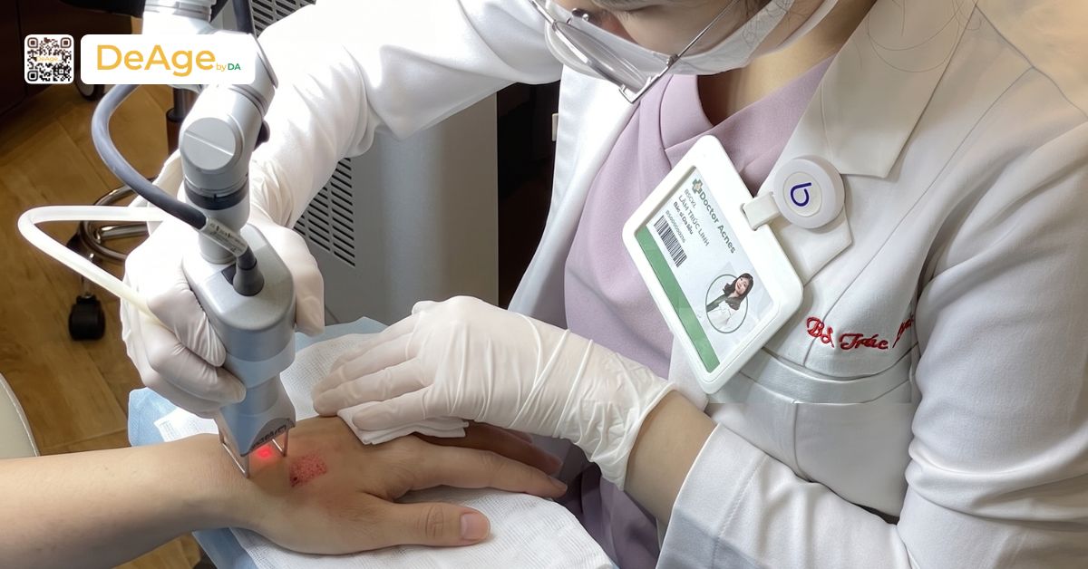 Da tay nhăn nheo do đâu và cách cải thiện giúp đôi tay mịn màng hơn 7 laser deka