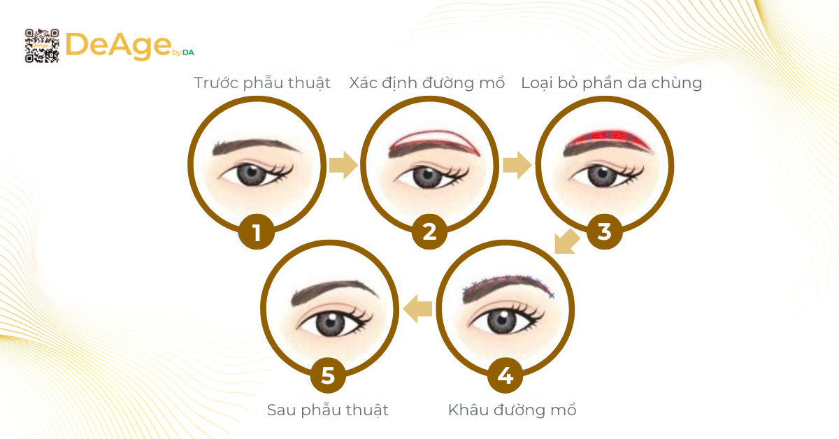 Nâng cơ mí mắt: bí quyết giúp vùng mắt trẻ trung và tươi tắn hơn 10 nâng cung chân mày