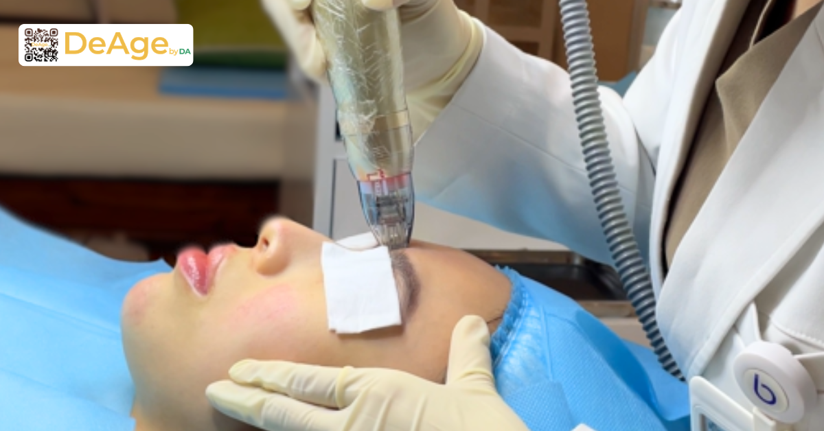 Nâng cơ mí mắt: bí quyết giúp vùng mắt trẻ trung và tươi tắn hơn 17 Công nghệ Sylfirm X vùng mắt tại DeAge by DA