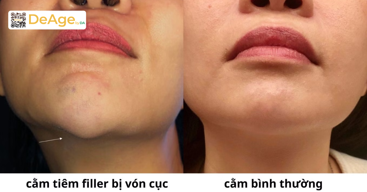 Giá tiêm tan filler bao nhiêu và những điều cần biết khi thực hiện 5 hiệu quả tiêm filler