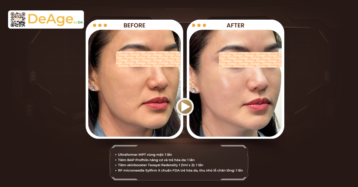 Bí quyết nâng cơ xóa nhăn không phẫu thuật giúp gương mặt trẻ trung hơn 9 CLS bio + skin