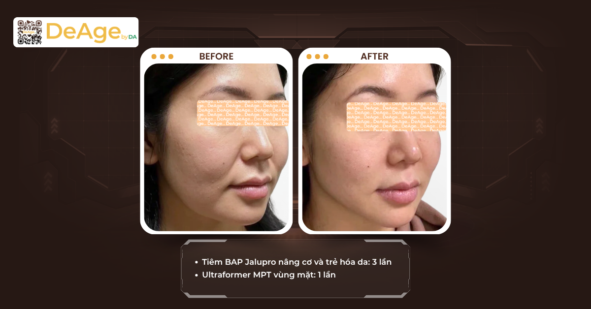 Tiêm trẻ hóa da: giải pháp cải thiện dấu hiệu lão hóa từ bên trong 3 cls tiêm trẻ hóa