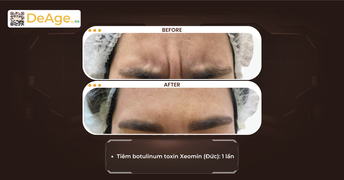 Da bị lão hóa sớm: dấu hiệu nhận biết, nguyên nhân và cách cải thiện 6 CLS botox