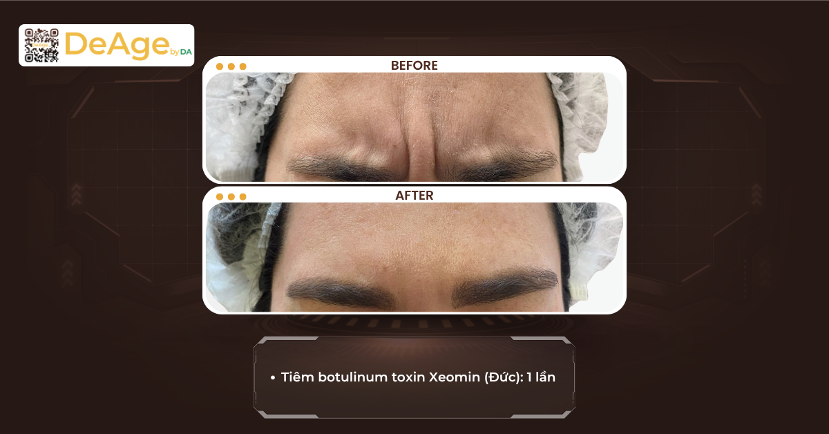 Xóa nhăn ấn đường: bí quyết giúp gương mặt hiền hòa, bớt cau có 6 CLS