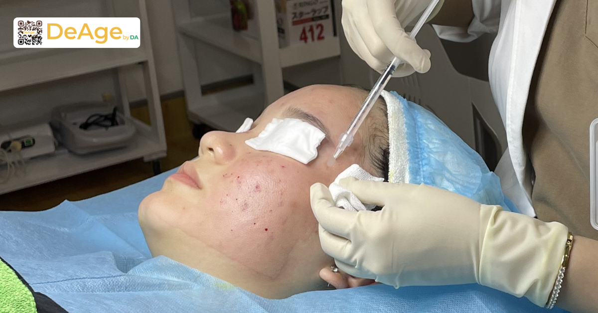 Cấy căng bóng da mang lại lợi ích gì và hiệu quả duy trì bao lâu? 2 Cấy căng bóng da là gì