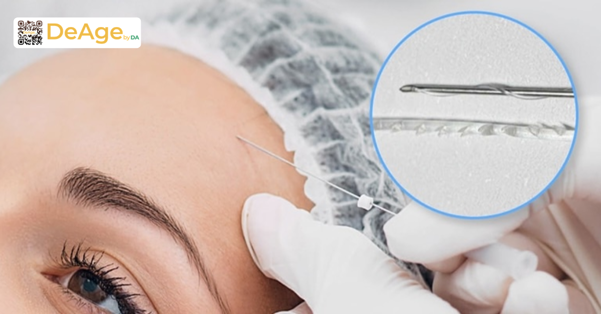 Xóa nhăn ấn đường: bí quyết giúp gương mặt hiền hòa, bớt cau có 10 Cấy chỉ sinh học