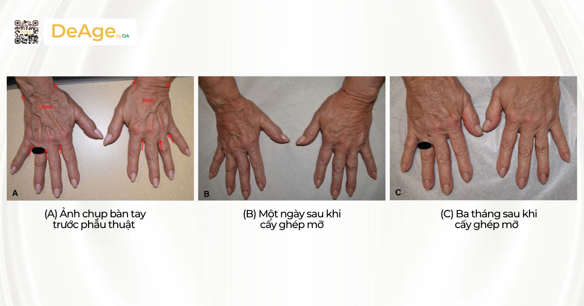 Cấy mỡ bàn tay: giải pháp cải thiện bàn tay gầy guộc và lão hóa 3 Hiệu quả
