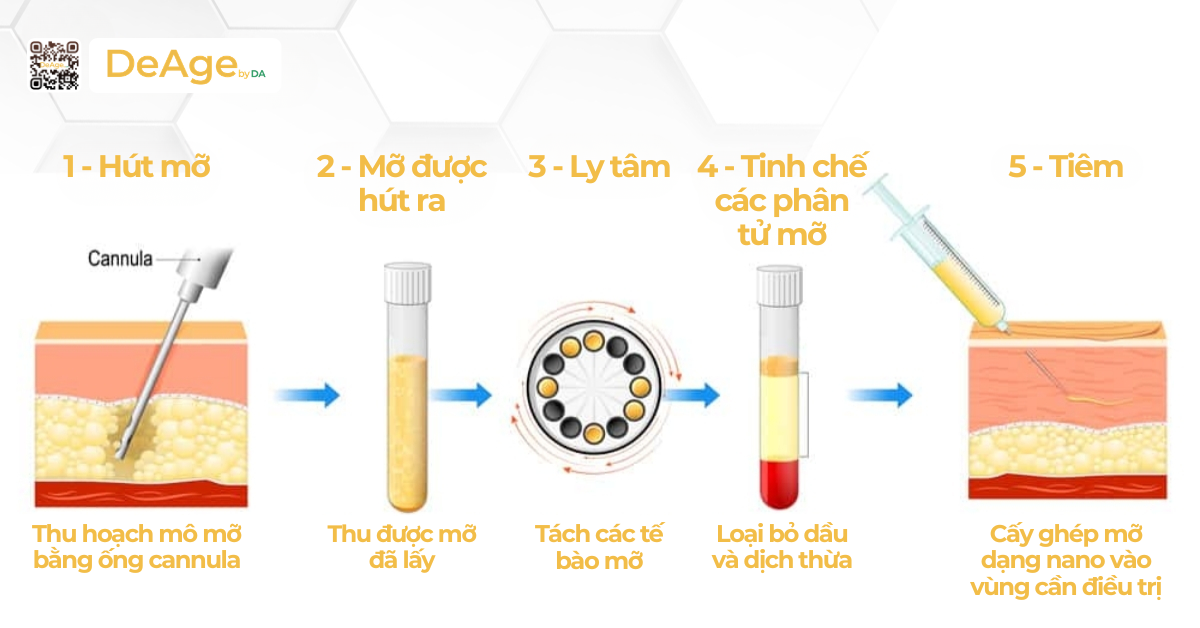 Cấy mỡ rãnh cười: quy trình, hiệu quả và những rủi ro cần biết 2 Cấy mỡ rãnh cười được thực hiện như thế nào